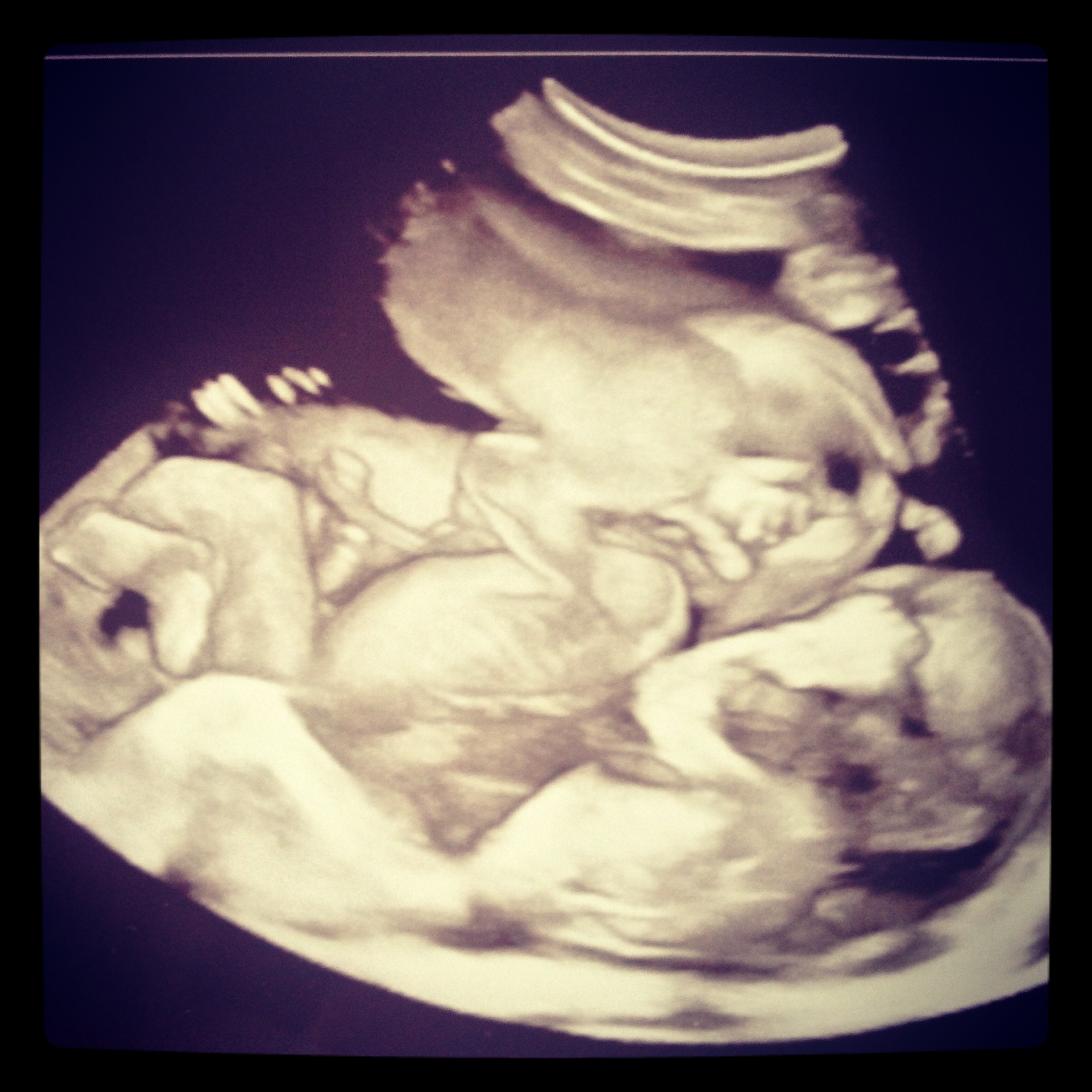 Pregnant With Twins Ultrasound 64
